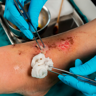 Curso Gratis en Prevención y Tratamiento de Heridas y Úlceras