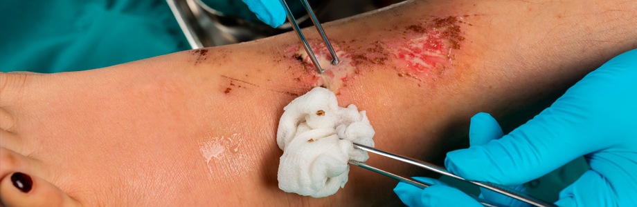 Curso Gratis en Prevención y Tratamiento de Heridas y Úlceras