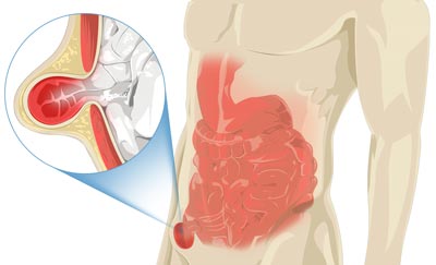 Existen distintos tipos de hernias.