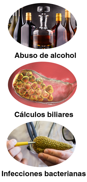 Los cálculos biliares, las infecciones y el abuso de alcohol son las causas más comunes.