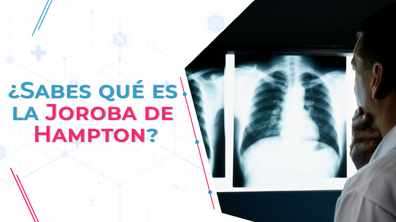 La joroba de Hampton es un signo radiológico clásico de la embolia pulmonar.