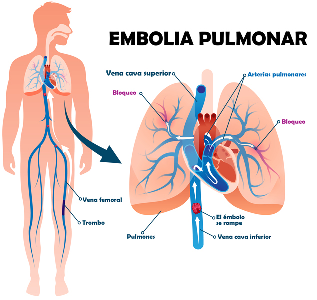 El infarto puede estar causado por una embolia pulmonar aguda.