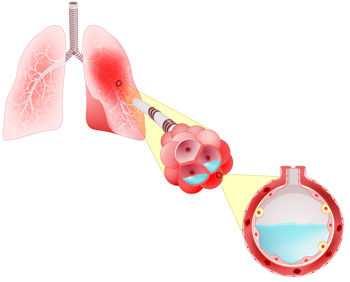 Los alvéolos se llenan de líquido
