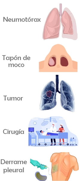 Algunas causas de la atelectasia