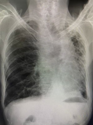 Para diagnosticar la atelectasia, los médicos generalmente comienzan con radiografías de tórax