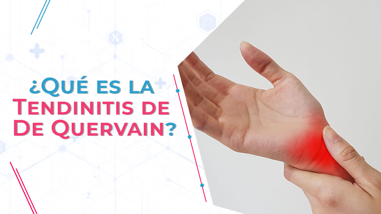 ¿Qué es la Tendinitis de De Quervain?