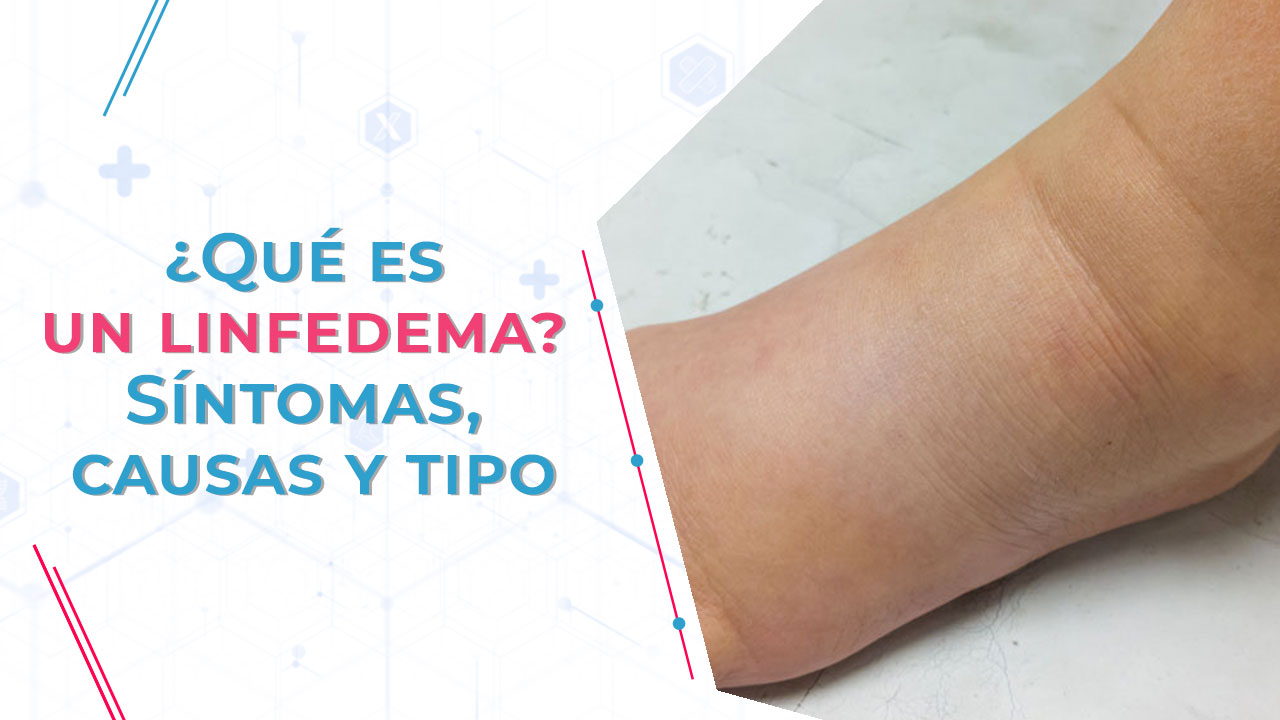 ¿Qué es un linfedema? Sintomas, causas y tipo