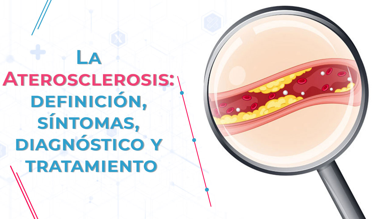 La aterosclerosis, definición, síntomas, diagnóstico y tratamiento