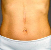 Incisión quirúrgica abdomen