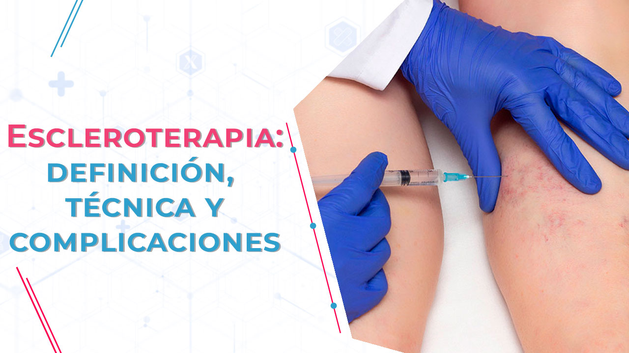Escleroterapia - Qué es, definición y complicaciones