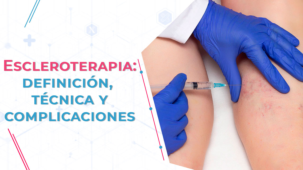 Escleroterapia - Qué es, definición y complicaciones