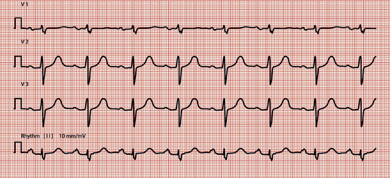 electrocardiograma