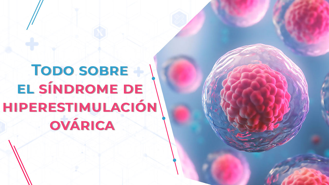 Sindrome de hiperestimulación ovárica