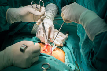 La apendicitis puede causar complicaciones graves.