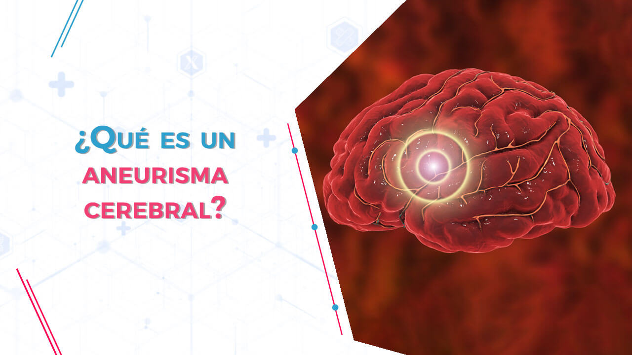 Un aneurisma es un ensanchamiento o abombamiento anormal de una parte de una arteria.