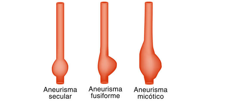 Existen tres tipos de aneurismas cerebrales.