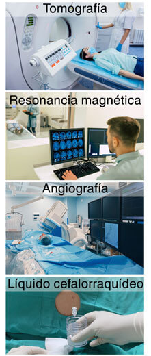 Existen varias pruebas para diagnosticar aneurismas cerebrales.