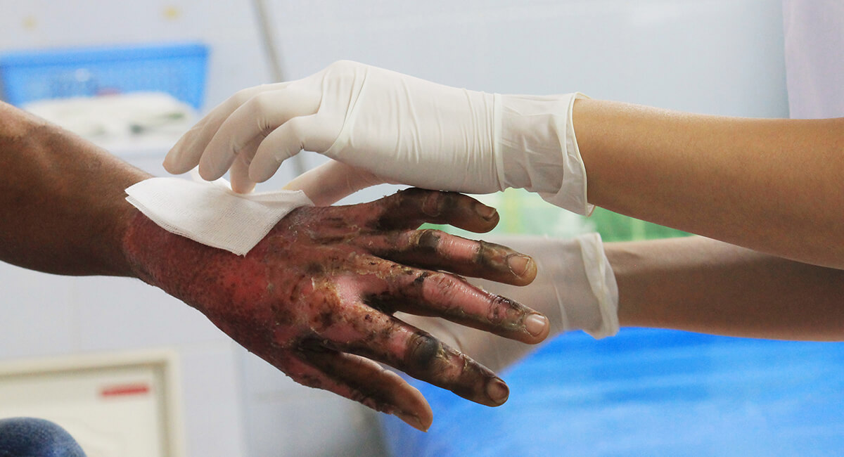 Curso internacional de manejo del paciente quemado crítico