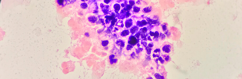 Curso Superior Universitario en Nuevo paradigma en las enfermedades infecciosas con implicación de Gram Positivos