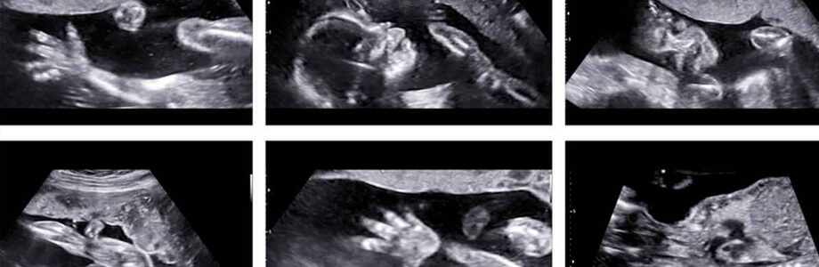 Curso Superior Universitario en Diagnóstico prenatal de anomalías congénitas fetales